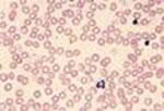 L'anemia mediterranea