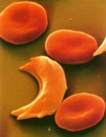 L'anemia falciforme 